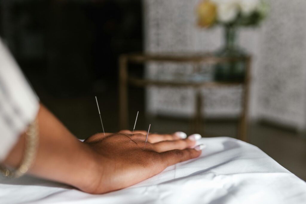 Top 10 benefits of acupuncture